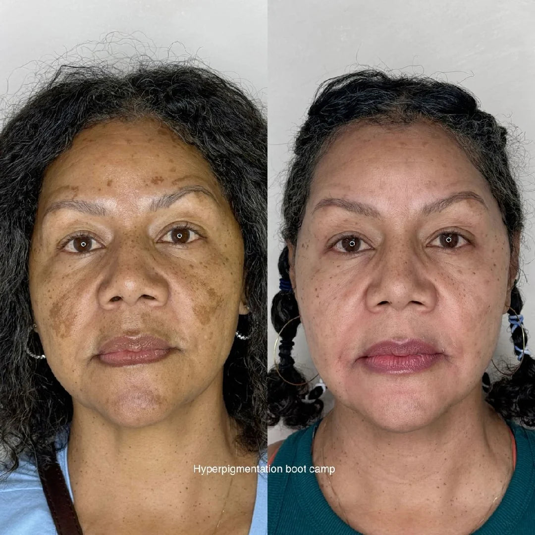 Clinically Inspired Formula for Dark Spots